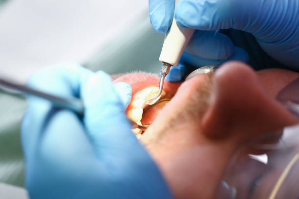 Best Emergency Root Canal Treatment in Chlicothe, IL